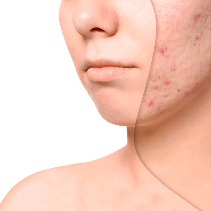 viso donna con acne prima e dopo il trattamento